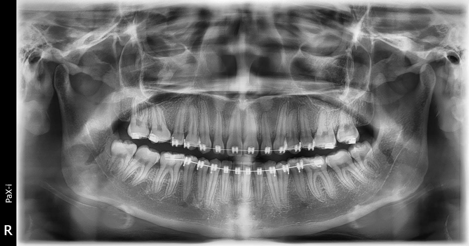 RADIOGRAFIA PANORAMICA DENTAL