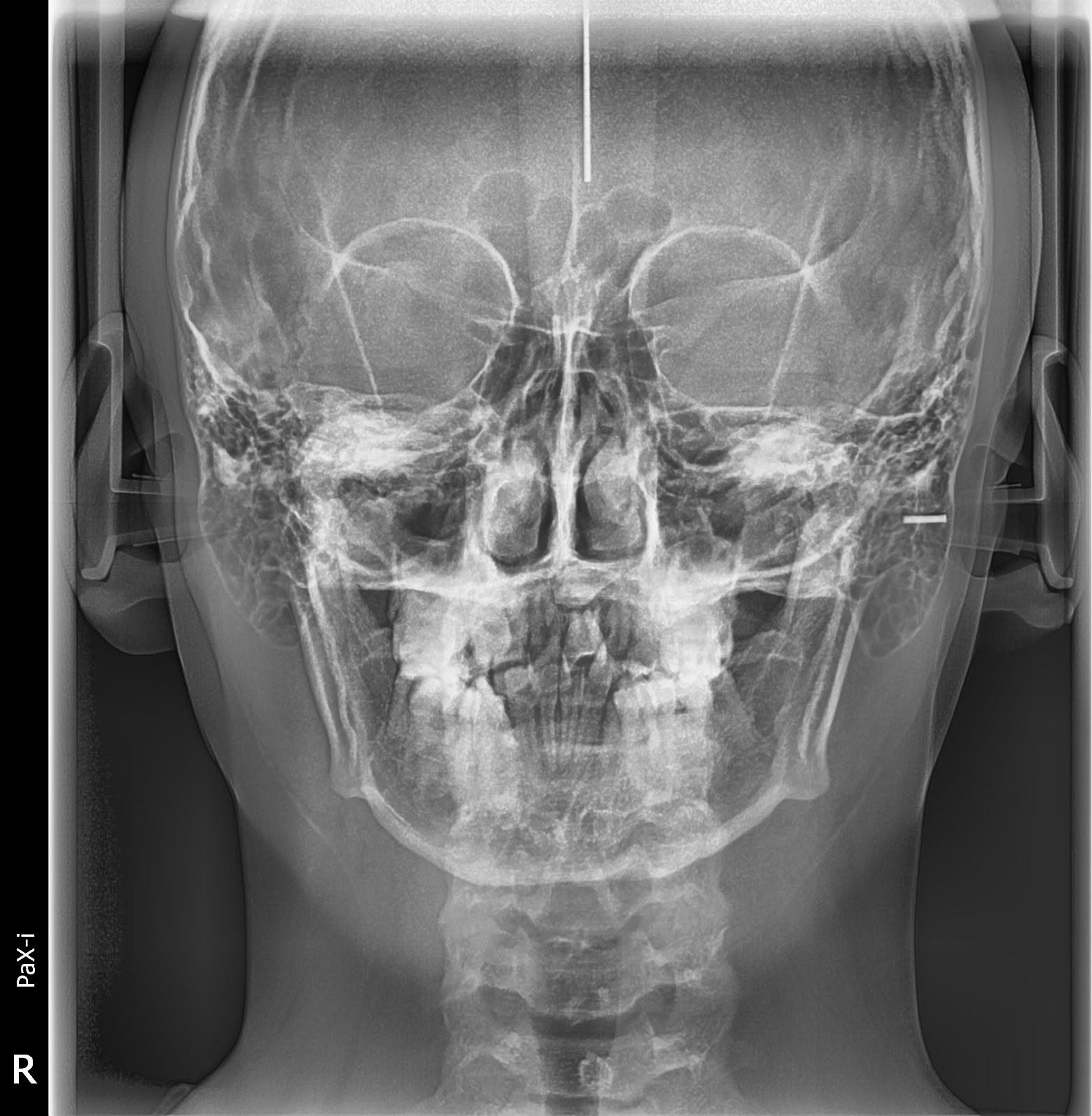 RADIOGRAFIA PANORAMICA DENTAL