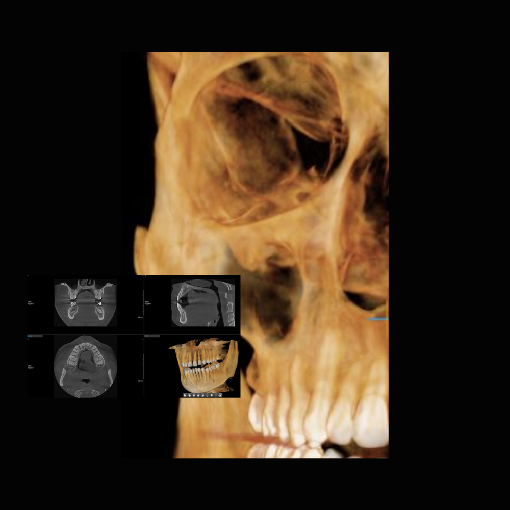 Radiografía Panorámica Dental RXS Tomografía o Cone Beam Dental