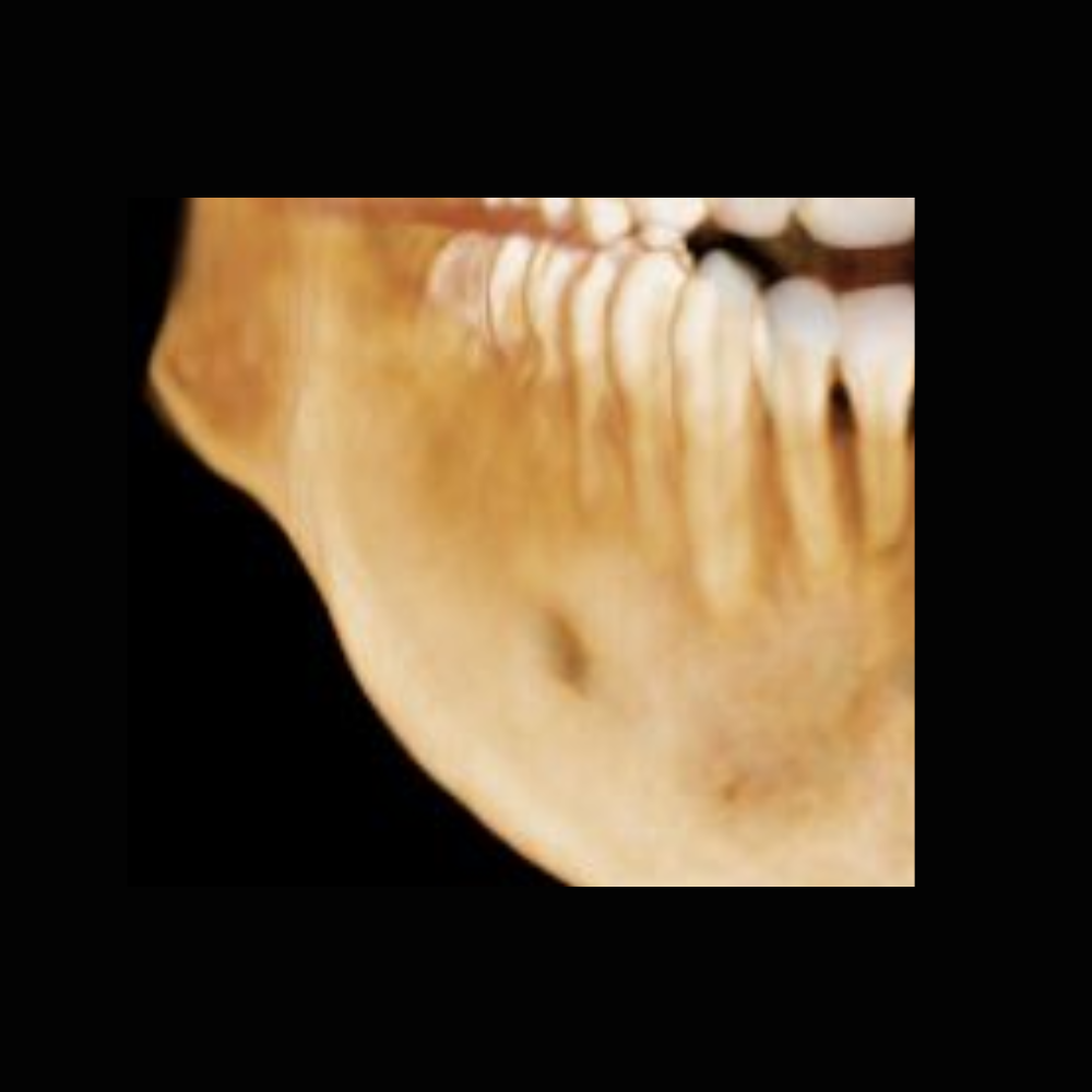 Radiografía Panorámica Dental RXS Tomografía o Cone Beam Dental