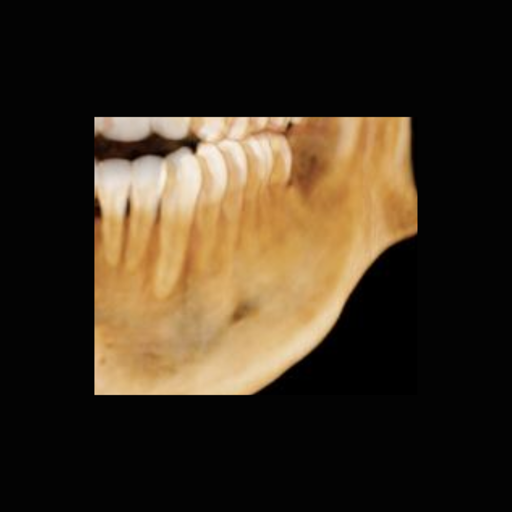 Radiografía Panorámica Dental RXS Tomografía o Cone Beam Dental