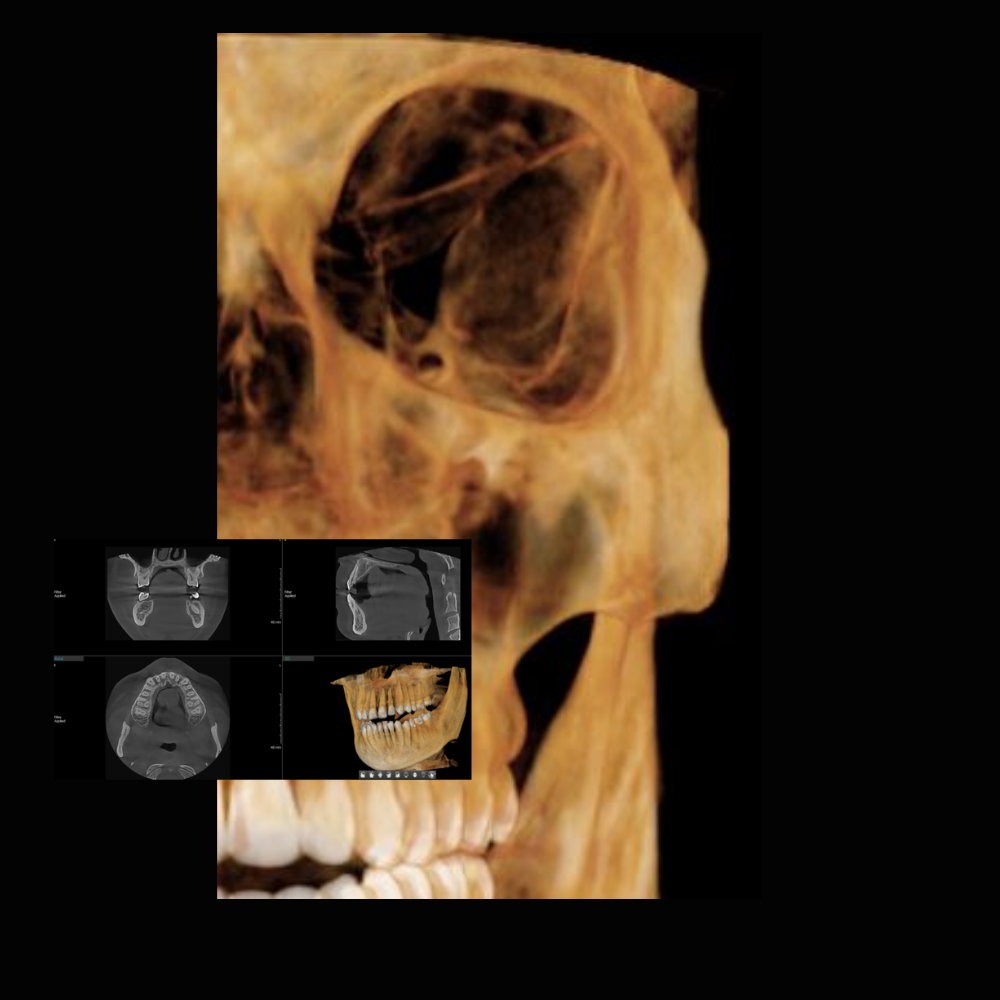 Radiografía Panorámica Dental RXS Tomografía o Cone Beam Dental