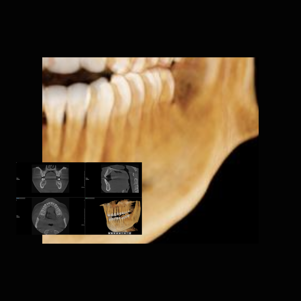 Radiografía Panorámica Dental RXS Tomografía o Cone Beam Dental
