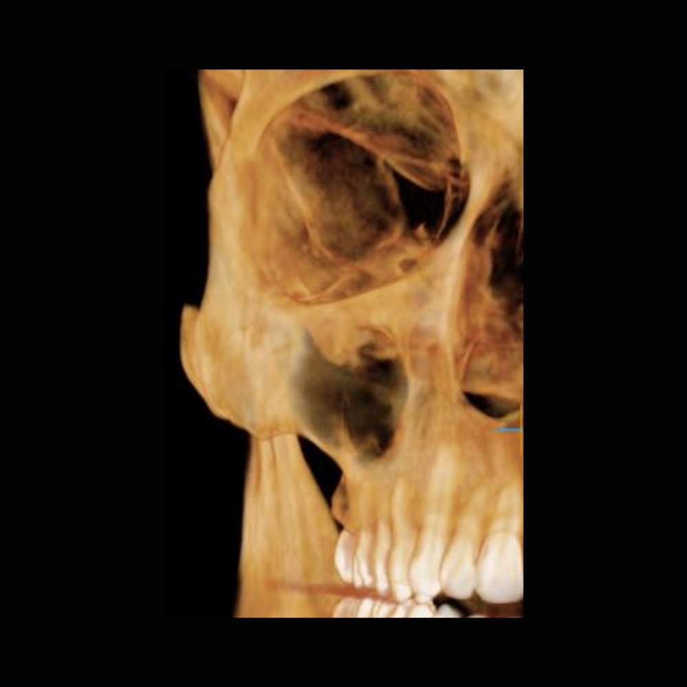 Radiografía Panorámica Dental RXS Tomografía o Cone Beam Dental