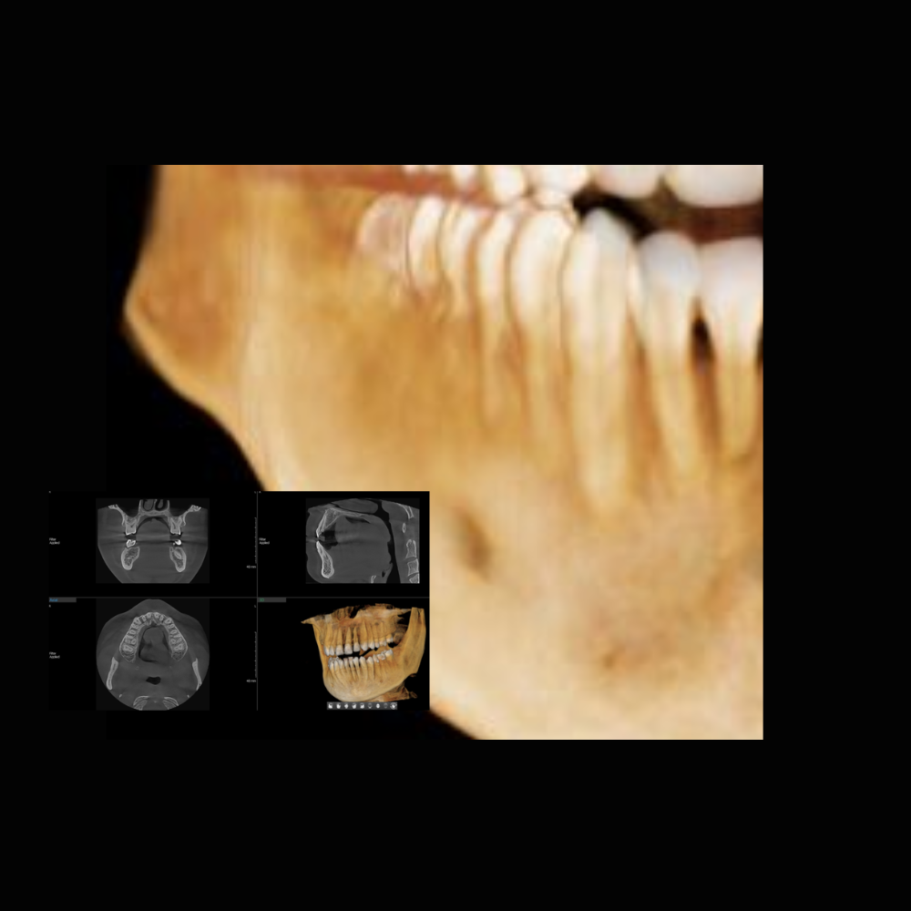 Radiografía Panorámica Dental RXS Tomografía o Cone Beam Dental