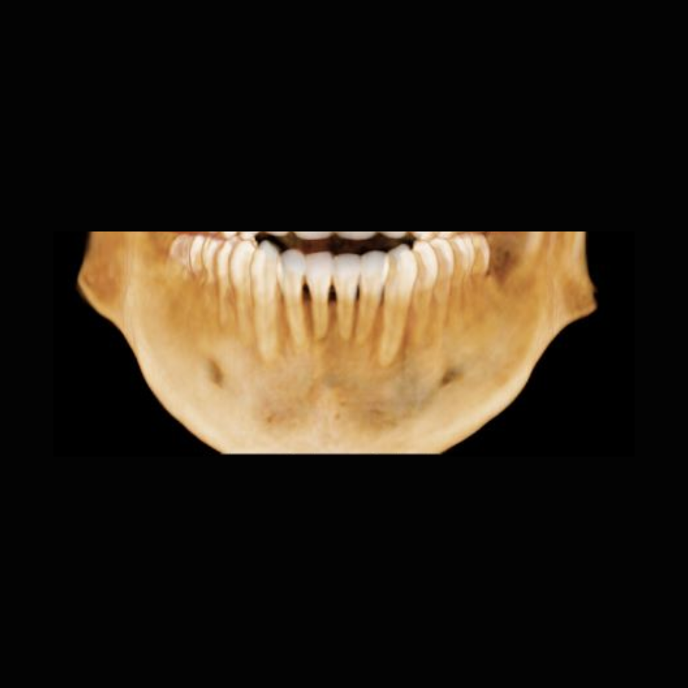 Radiografía Panorámica Dental RXS Tomografía o Cone Beam Dental