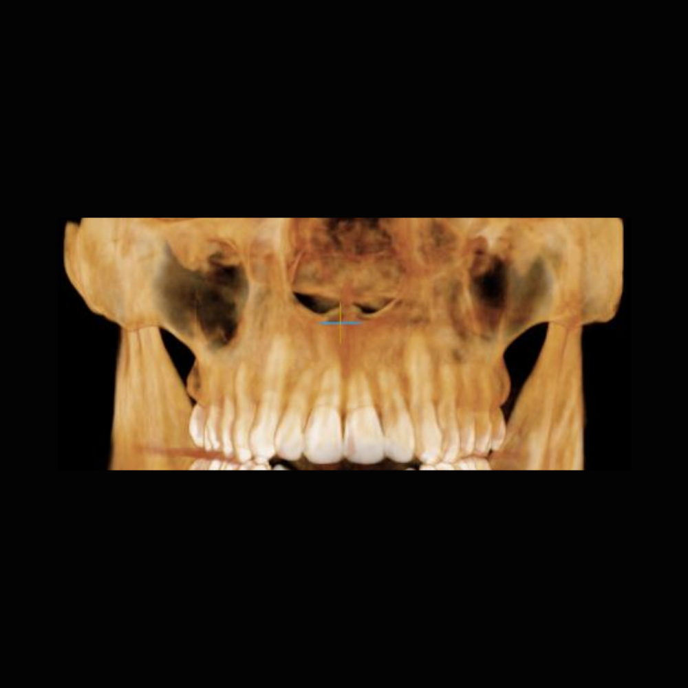 Radiografía Panorámica Dental RXS Tomografía o Cone Beam Dental